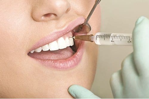 Bọc răng sứ có tốt không nên bọc ở đâu để thực sự an tâm?