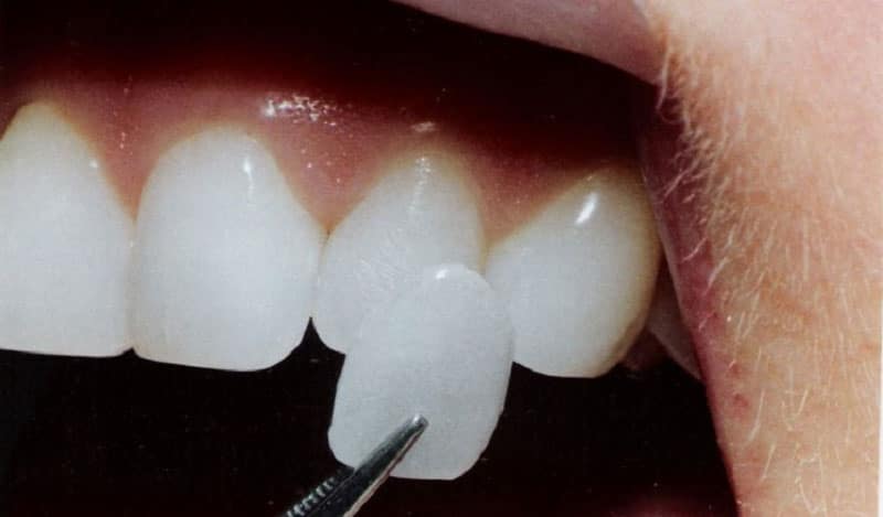 Dán răng sứ là gì