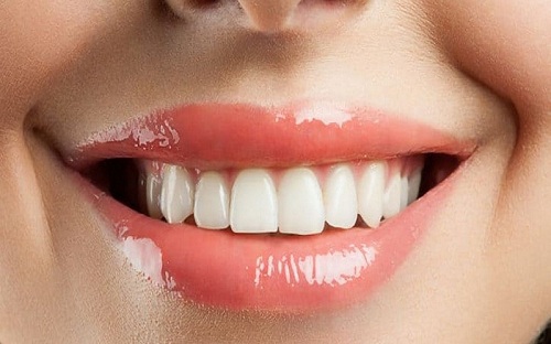 Top những câu hỏi liên quan đến răng sứ titan mọi người cần biết