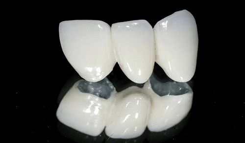Đi tìm sự khác nhau giữa răng sứ titan và răng toàn sứ