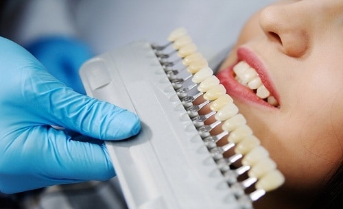 Những điều cần biết về răng sứ zirconia trước tiến hành làm
