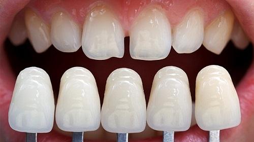 Bọc răng sứ răng cửa bị thưa: Nên chọn loại răng nào?