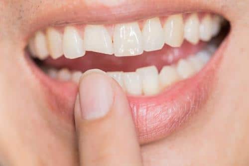 Hãy khoan bọc răng sứ khi chưa biết bọc răng sứ có tác hại gì?
