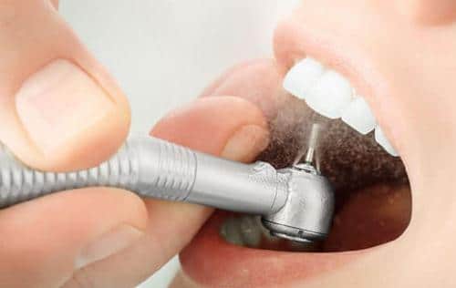 Cách bọc răng sứ đạt chuẩn được bộ Y tế kiểm định chất lượng