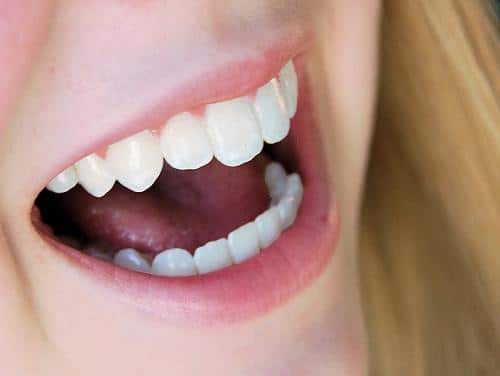 Dán răng sứ không mài răng: Sự lựa chọn tối ưu cho mọi người