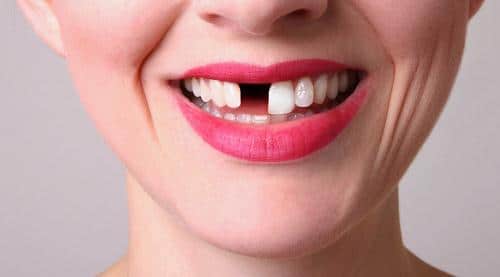 Làm cầu răng sứ khác với bọc răng sứ ở những điểm nào?