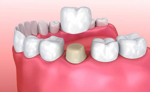Răng bị mẻ nên bọc hay trám răng sứ?
