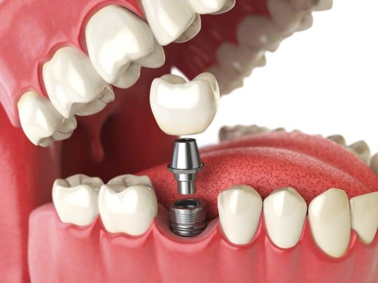 giá trồng răng implant hiện nay bao nhiêu-1