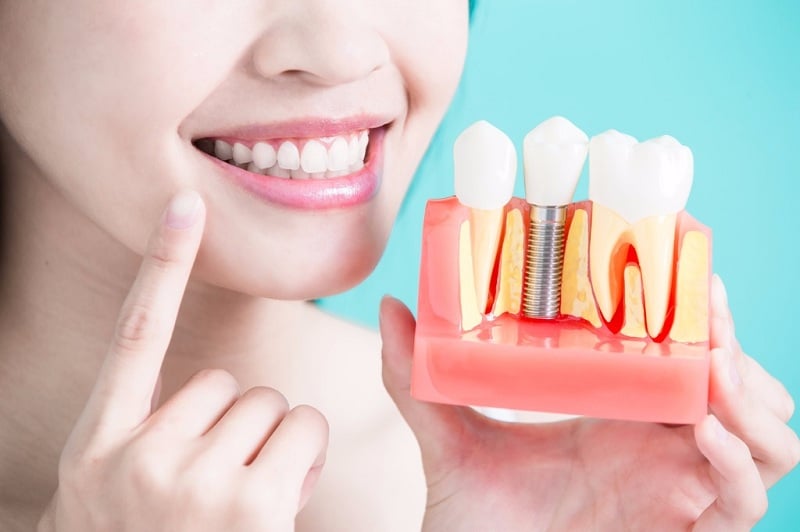 giá trồng răng implant hiện nay bao nhiêu-2