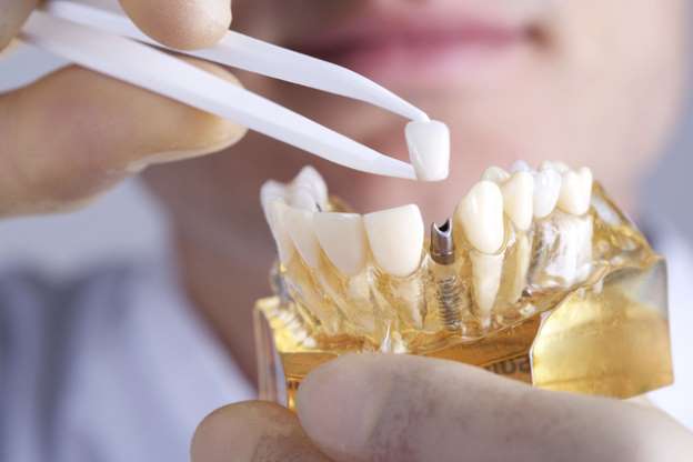 giá trồng răng implant hiện nay bao nhiêu